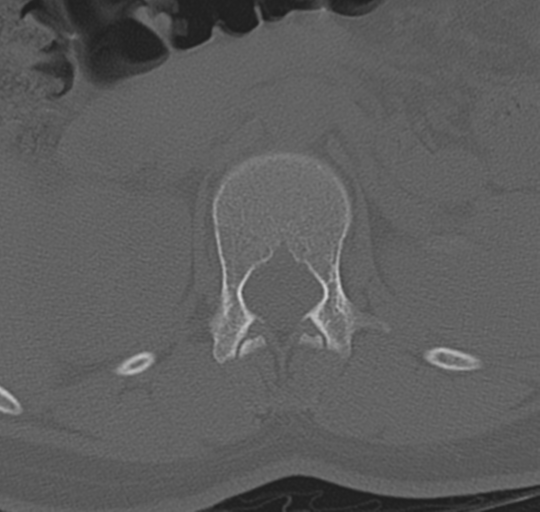 File:Normal lumbosacral CT (Radiopaedia 37923-39867 Axial bone window 30).png