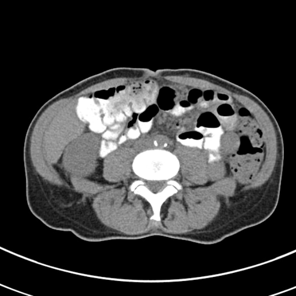File:Normal multiphase CT liver (Radiopaedia 38026-39996 Axial non-contrast 49).jpg