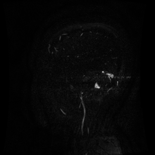 Normal noncontrast MR venography (Radiopaedia 87578-103957 A 26).jpg