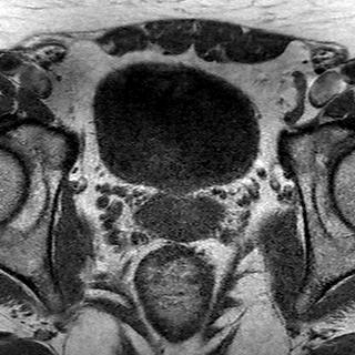 File:Normal prostate (MRI) (Radiopaedia 29986-30535 Axial T1 15).jpg