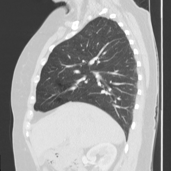 Obstructing typical carcinoid causing bronchoceles (Radiopaedia 50149-55476 Sagittal lung window 20).png