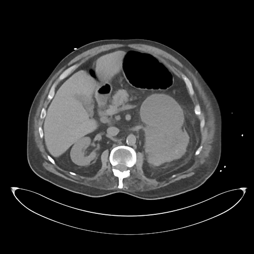 File:Obstructive pyelonephritis (Radiopaedia 46411-50844 Axial non-contrast 30).png