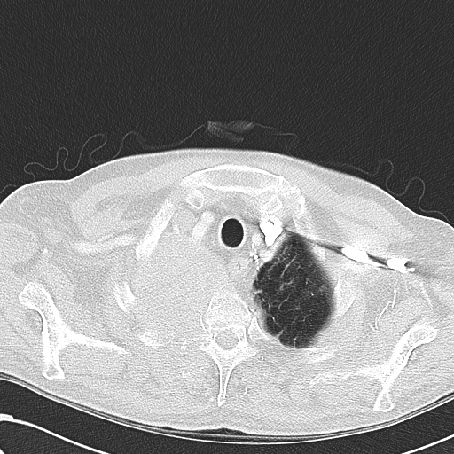 File:Obstructive superior vena cava tumor thrombus (Radiopaedia 28046-28306 Axial lung window 7).jpg