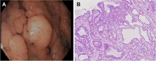 a)Pedunculated adenoma, b) photomicrograph of the same polyp showing an adenoma with low grade dysplasia