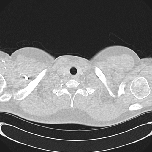 File:'Bovine' aortic arch (Radiopaedia 33554-34637 Axial lung window 3).png