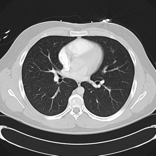 File:'Bovine' aortic arch (Radiopaedia 33554-34637 Axial lung window 32).png