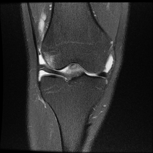 File:ACL acute full thickness tear - deep lateral femoral sulcus sign (Radiopaedia 38594-40740 Coronal PD fat sat 9).jpg