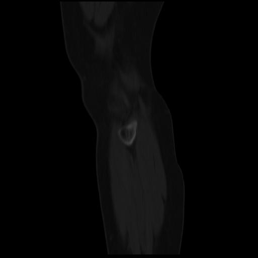 File:ACL avulsion fracture (Radiopaedia 33833-34994 Sagittal bone window 3).jpg