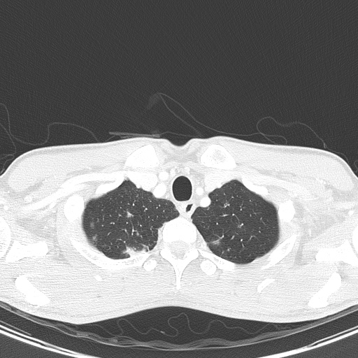 AIDS-related Kaposi sarcoma (Radiopaedia 85247-100811 Axial lung window 17).jpg