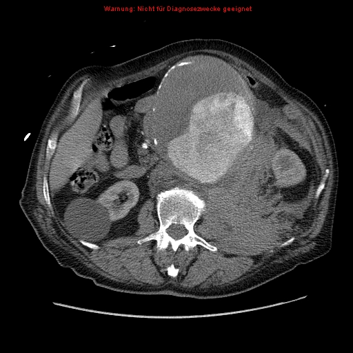Abdominal aortic aneurysm- extremely large, ruptured (Radiopaedia 19882-19921 Axial C+ arterial phase 30).jpg