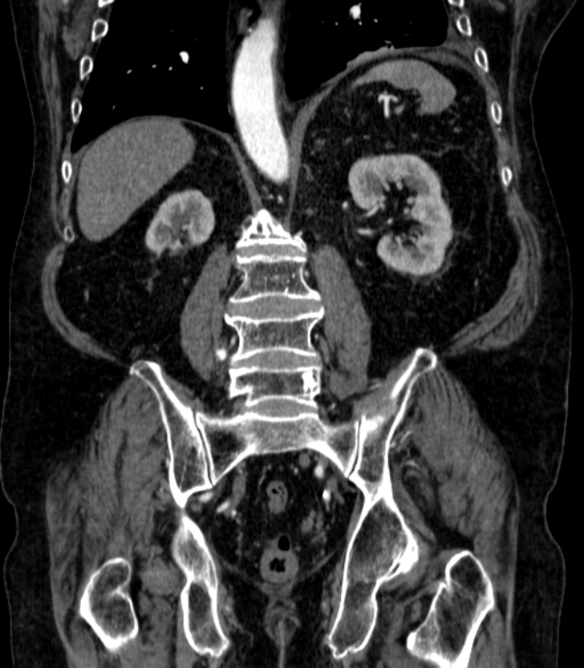 Abdominal aortic aneurysm (Radiopaedia 25855-26001 Coronal C+ arterial phase 51).jpg