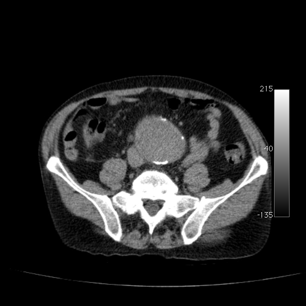 Abdominal aortic aneurysm (Radiopaedia 29248-29660 Axial non-contrast 39).jpg