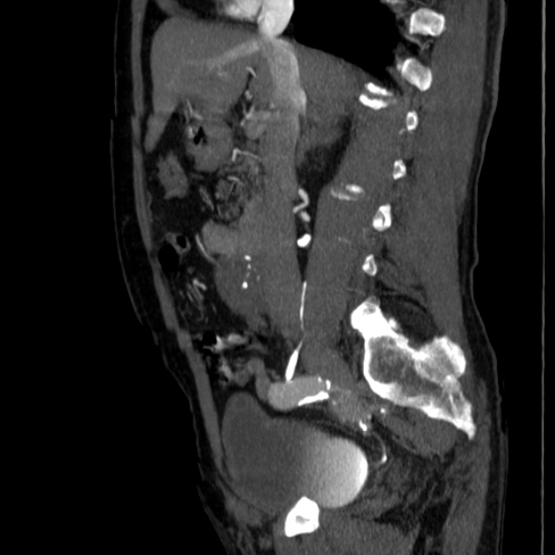 Abdominal aortic aneurysm (Radiopaedia 29248-29660 Sagittal C+ arterial phase 21).jpg
