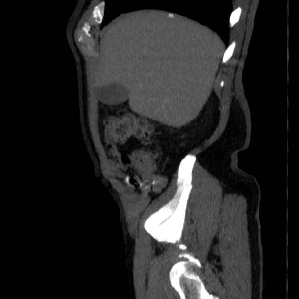 Abdominal aortic aneurysm (Radiopaedia 29248-29660 Sagittal C+ arterial phase 7).jpg