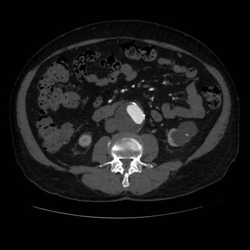 File:Abdominal aortic aneurysm (Radiopaedia 57318-64259 Axial C+ arterial phase 39).jpg