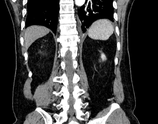 File:Abdominal aortic aneurysm (Radiopaedia 67117-76452 Coronal C+ arterial phase 85).jpg