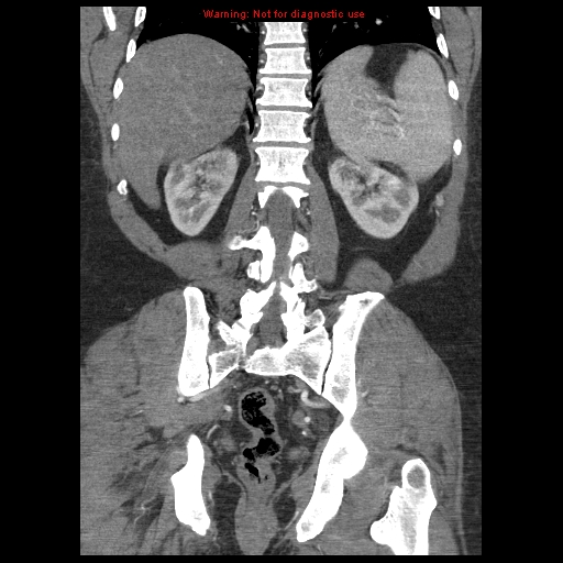 Abdominal aortic aneurysm (Radiopaedia 8190-9038 Coronal C+ arterial phase 94).jpg