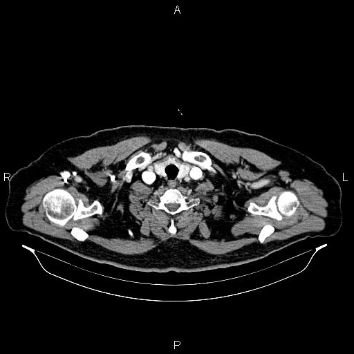Abdominal aortic aneurysm (Radiopaedia 83094-97462 Axial renal cortical phase 4).jpg