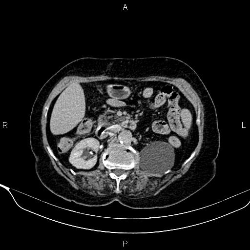 Abdominal aortic aneurysm (Radiopaedia 85063-100606 Axial C+ delayed 41).jpg