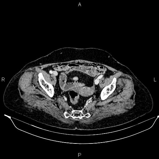 File:Abdominal aortic aneurysm (Radiopaedia 85063-100606 Axial C+ portal venous phase 59).jpg