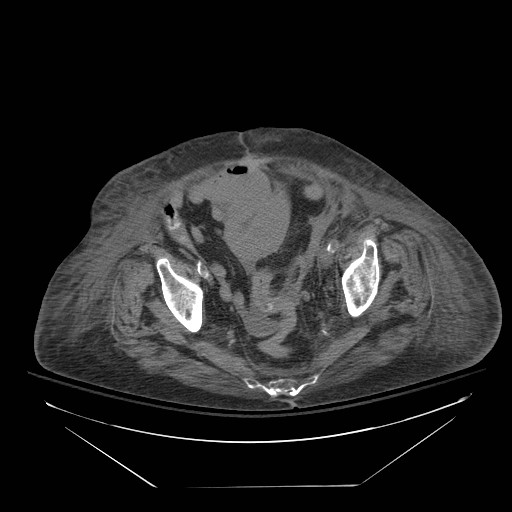 Abdominal aortic aneurysm - impending rupture (Radiopaedia 19233-19247 Axial non-contrast 141).jpg