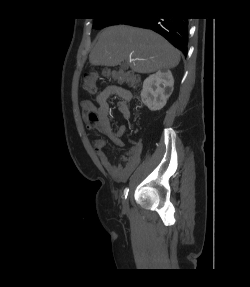 Abdominal aortic aneurysm with thrombus fissuration (Radiopaedia 46218-50618 Sagittal C+ arterial phase 16).jpg
