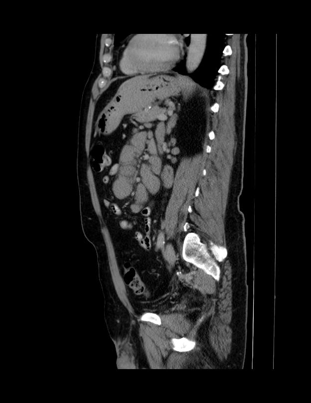 Abdominal lymphoma - with sandwich sign (Radiopaedia 53486-59492 Sagittal C+ portal venous phase 30).jpg
