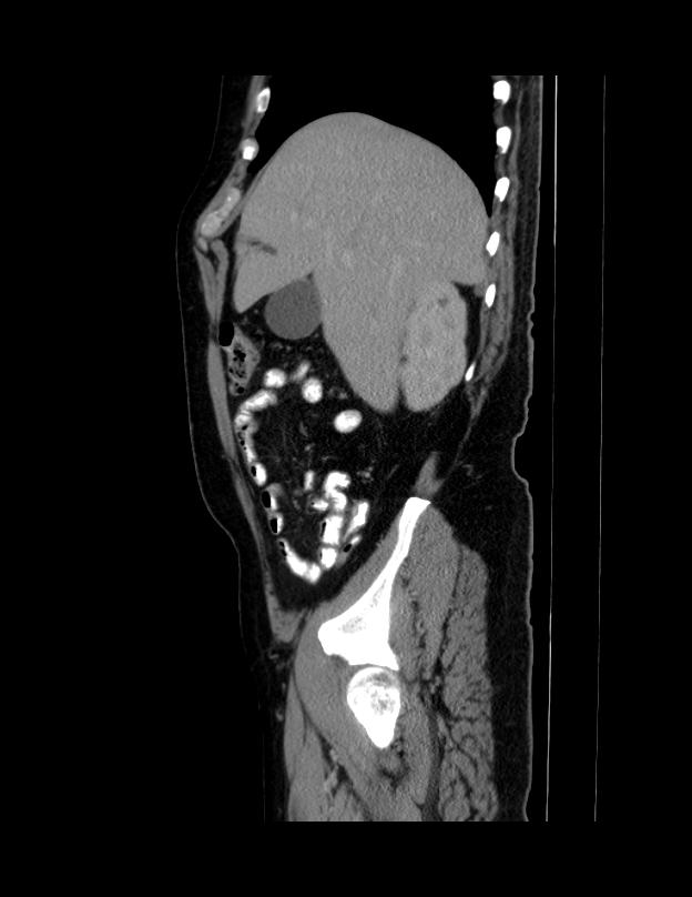 Abdominal lymphoma - with sandwich sign (Radiopaedia 53486-59492 Sagittal C+ portal venous phase 62).jpg