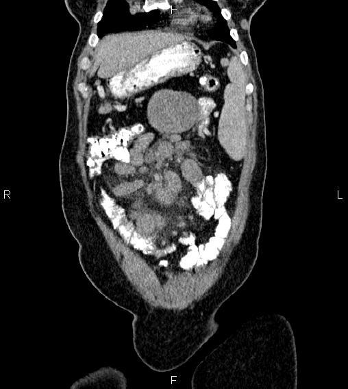File:Abdominal lymphoma with sandwich sign (Radiopaedia 84378-99704 Coronal C+ portal venous phase 6).jpg