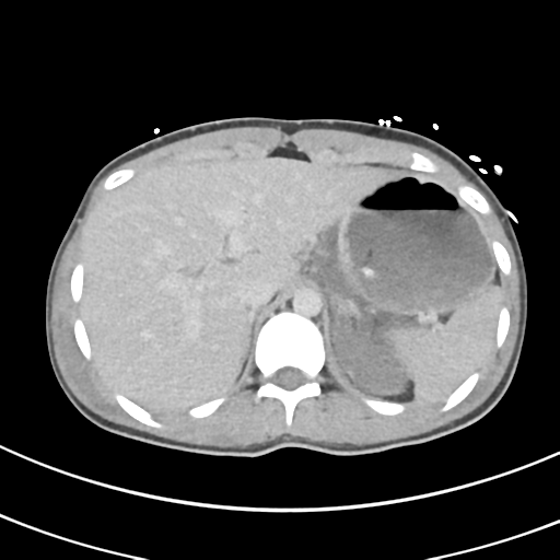 File:Abdominal multi-trauma - devascularised kidney and liver, spleen and pancreatic lacerations (Radiopaedia 34984-36486 Axial C+ delayed 15).png