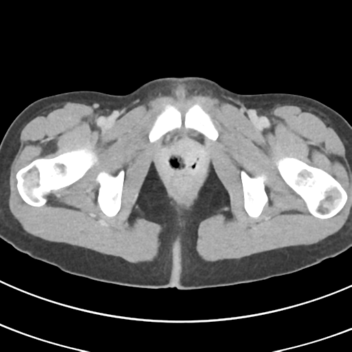 File:Abdominal multi-trauma - devascularised kidney and liver, spleen and pancreatic lacerations (Radiopaedia 34984-36486 Axial C+ delayed 82).png