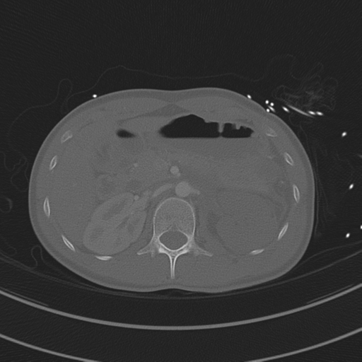 File:Abdominal multi-trauma - devascularised kidney and liver, spleen and pancreatic lacerations (Radiopaedia 34984-36486 I 103).png