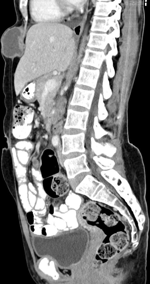 Abdominal wall and retroperitoneal tuberculosis (Radiopaedia 88137-104729 Sagittal C+ portal venous phase 75).jpg