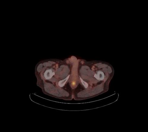 Abdominal wall metastasis from colorectal carcinoma (Radiopaedia 31016-31719 C 14).jpg