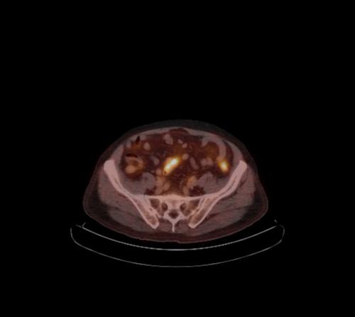 Abdominal wall metastasis from colorectal carcinoma (Radiopaedia 31016-31719 C 41).jpg
