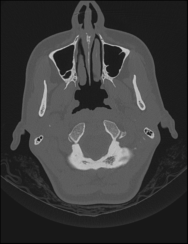 Aberrant right internal carotid artery (Radiopaedia 65191-74198 Axial non-contrast 7).jpg