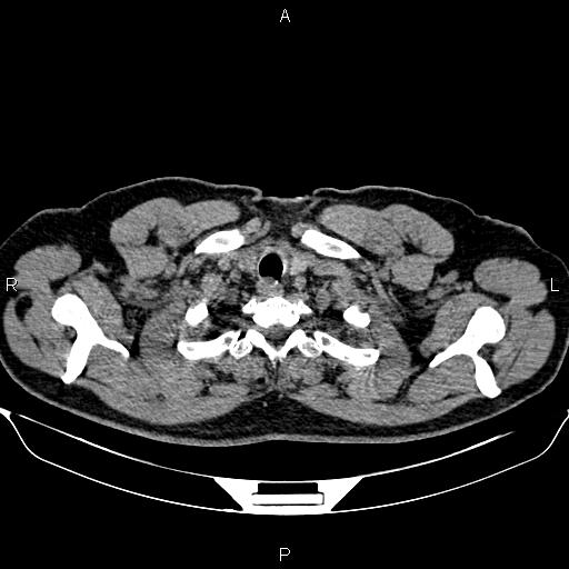 File:Aberrant right subclavian artery (Radiopaedia 87093-103354 Axial non-contrast 7).jpg