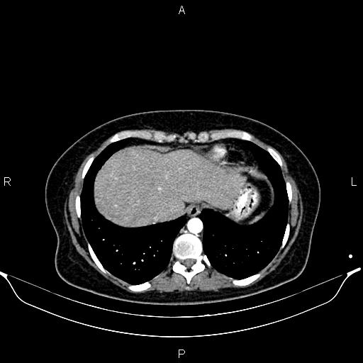 File:Aberrant right subclavian artery (Radiopaedia 87334-103629 Axial C+ arterial phase 53).jpg