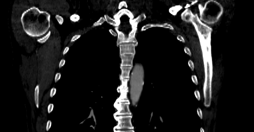 Accesory rib joint (Radiopaedia 71987-82452 Coronal bone window 26).jpg