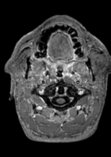 Accessory middle cerebral artery (Radiopaedia 73114-83828 Axial T1 C+ 222).jpg