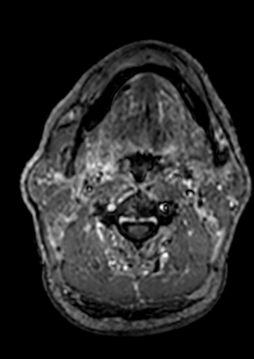 Accessory middle cerebral artery (Radiopaedia 73114-83828 Axial T1 C+ 293).jpg