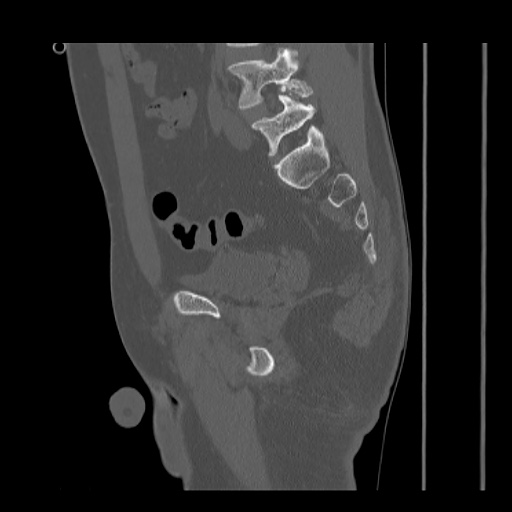 Acetabular and ilial fractures (Radiopaedia 59084-66378 Sagittal bone window 60).jpg