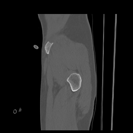 Acetabular and ilial fractures (Radiopaedia 59084-66378 Sagittal bone window 7).jpg