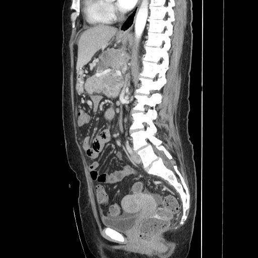Acinar cell carcinoma of the pancreas (Radiopaedia 75442-86669 Sagittal C+ portal venous phase 104).jpg