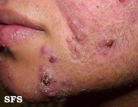 File:Acne (Dermatology Atlas 6).jpg