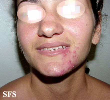 Acne Rosacea (Dermatology Atlas 17).jpg