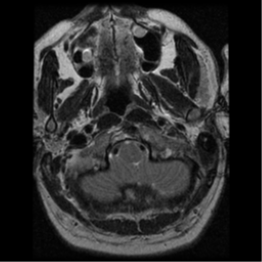 File:Acoustic schwannoma (Radiopaedia 39170-41387 Axial T2 1).png