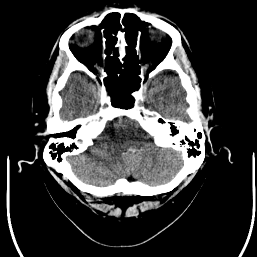 File:Acoustic schwannoma (Radiopaedia 39170-41389 Axial non-contrast 5).png