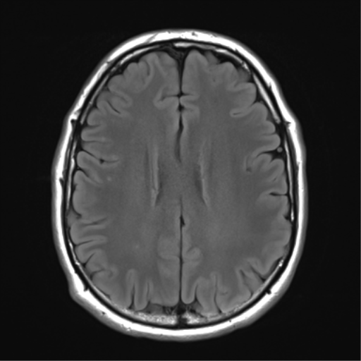 File:Acoustic schwannoma (Radiopaedia 50846-56358 Axial FLAIR 21).png