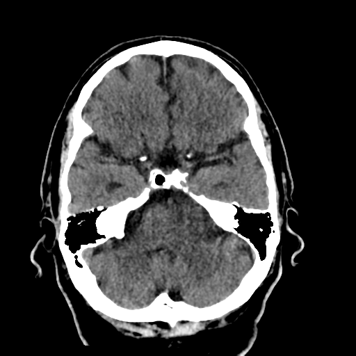 File:Acoustic schwannoma (Radiopaedia 55729-62280 Axial non-contrast 11).png
